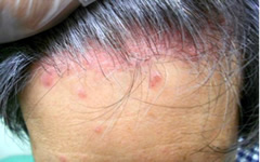 尋常性乾癬による頭部の皮疹
